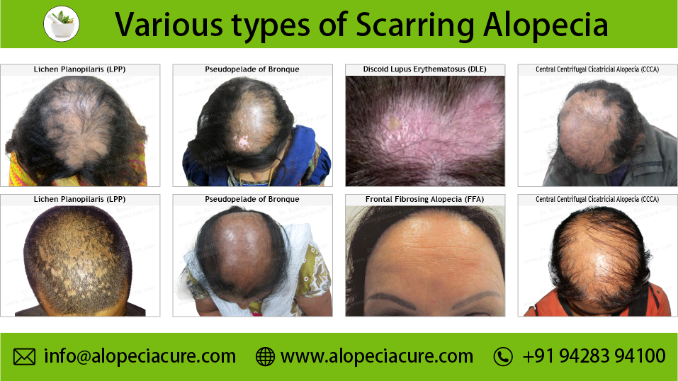 types scarring alopecia