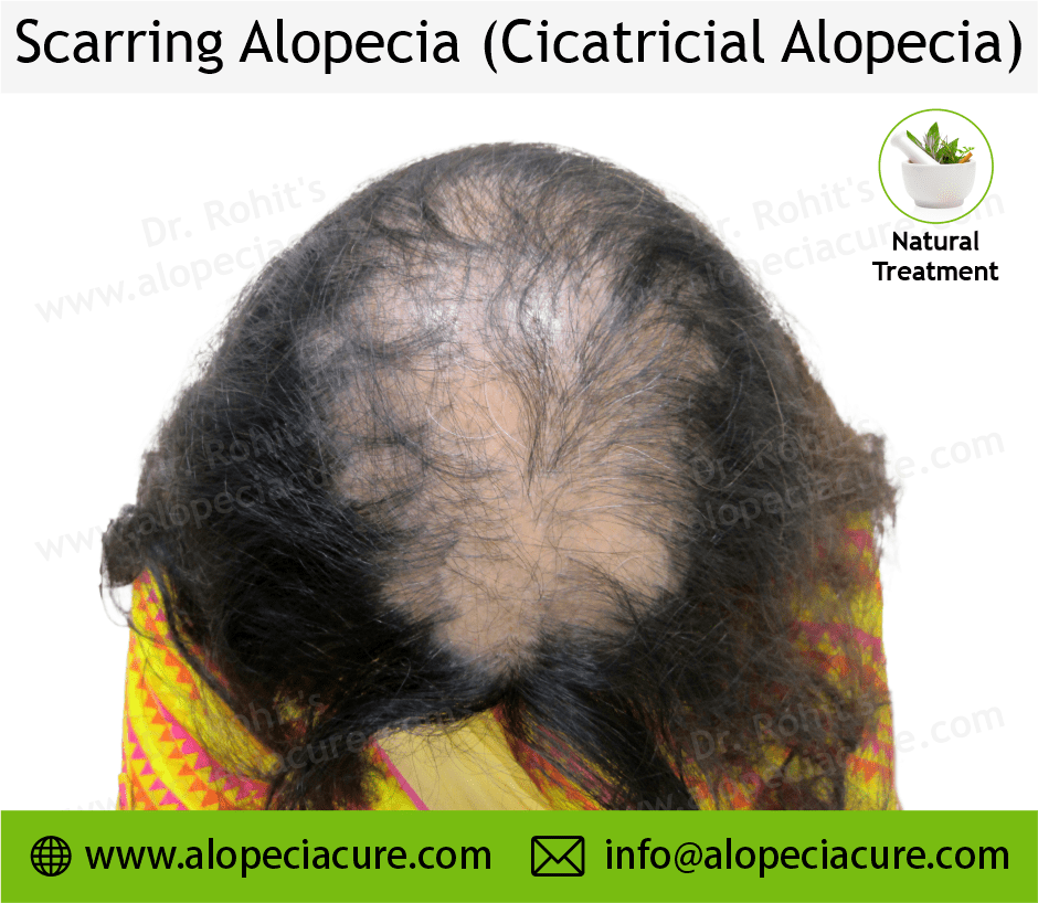 Scarrring Alopecia