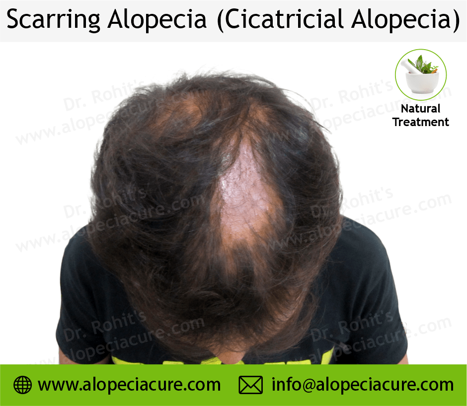 Scarrring Alopecia