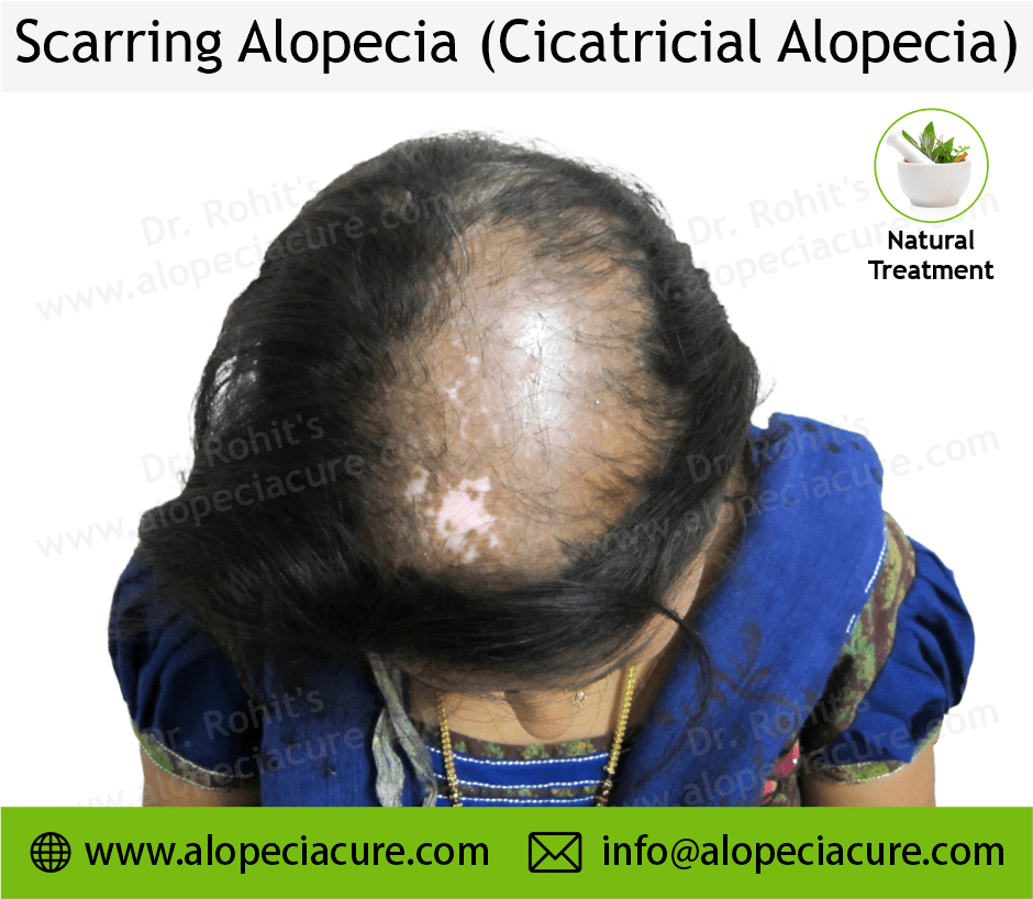 Scarrring Alopecia