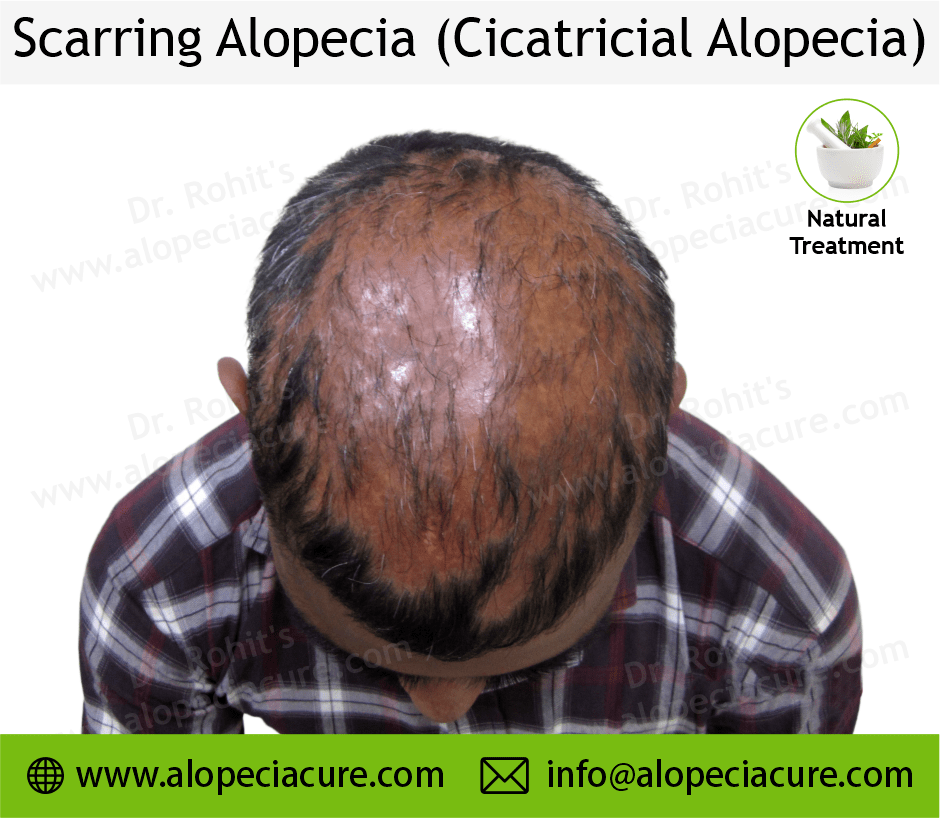 Scarrring Alopecia