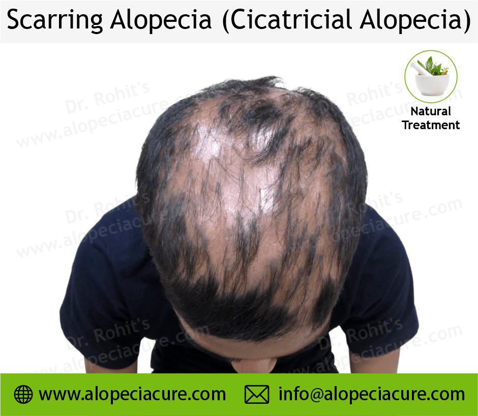 Scarrring Alopecia
