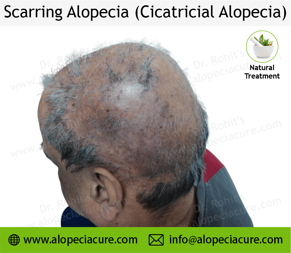 Scarrring Alopecia