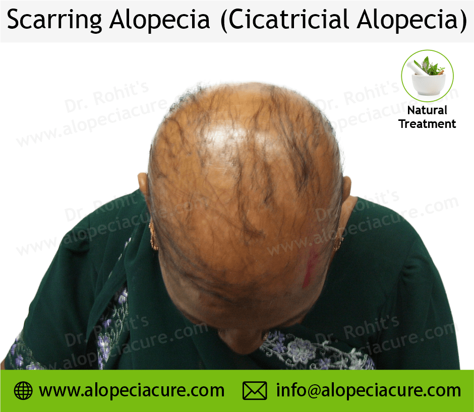 Scarrring Alopecia