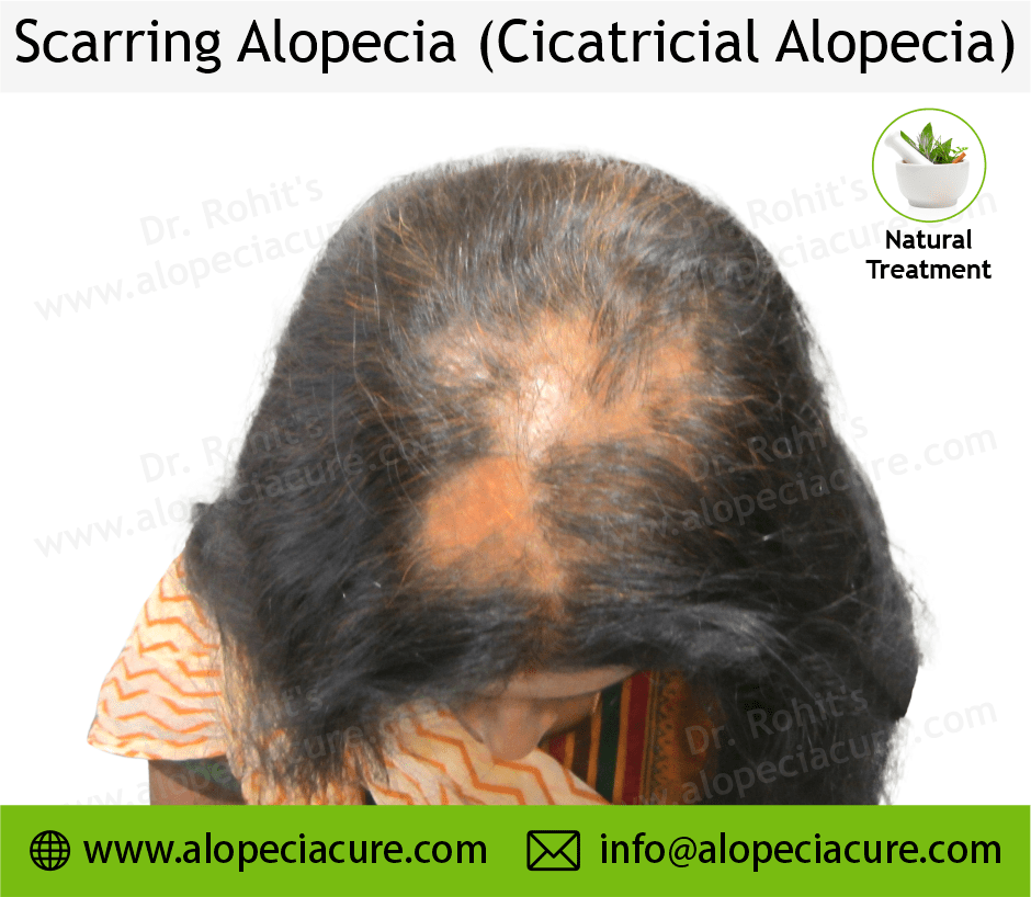 Scarrring Alopecia