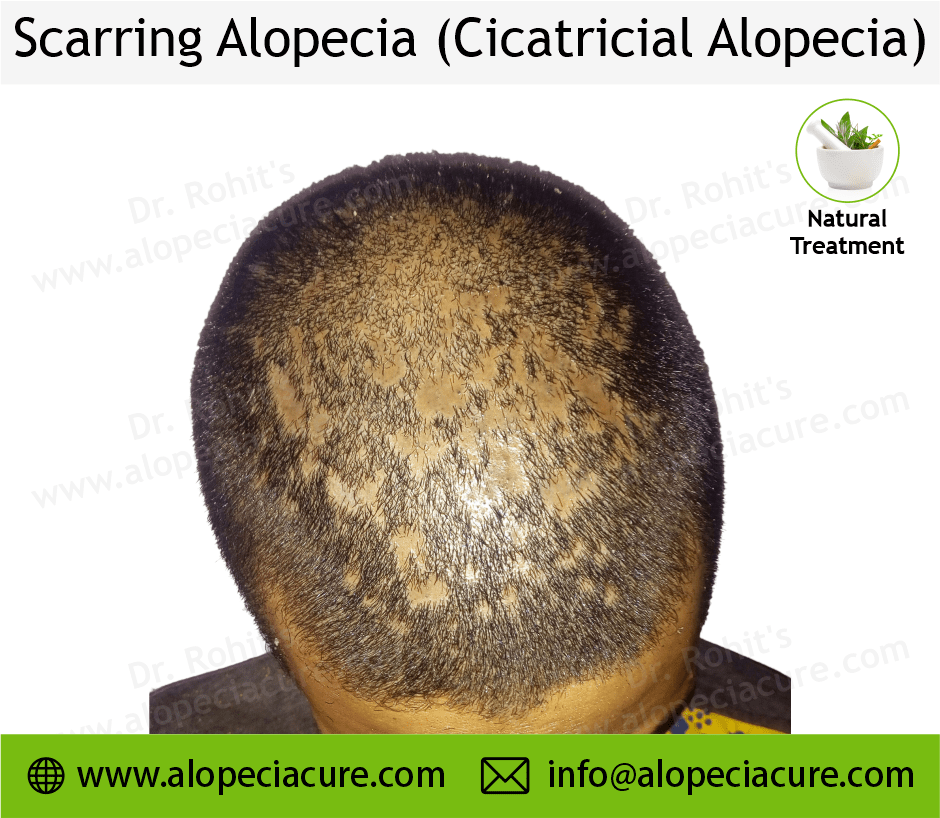 Scarrring Alopecia