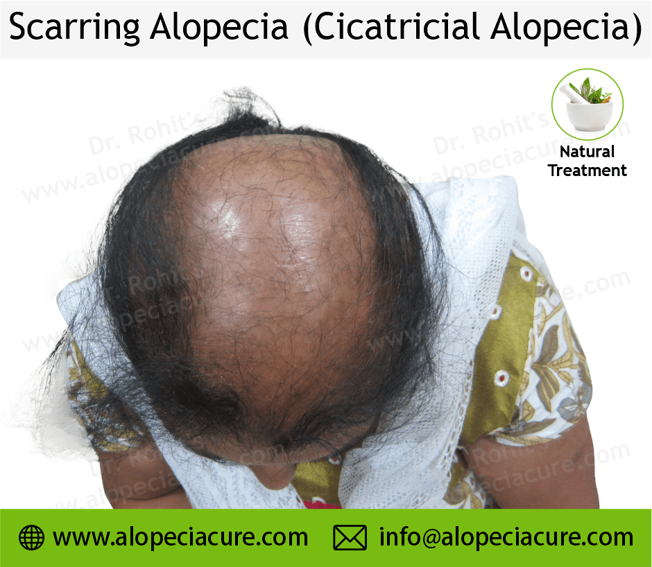 Scarrring Alopecia