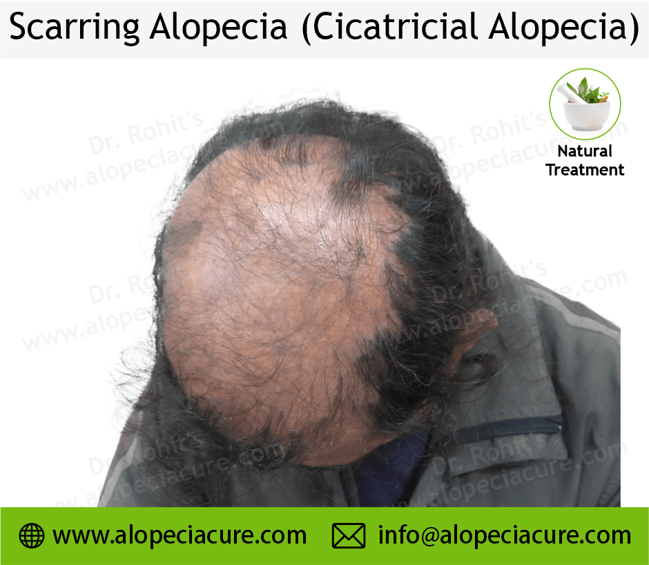 Scarrring Alopecia