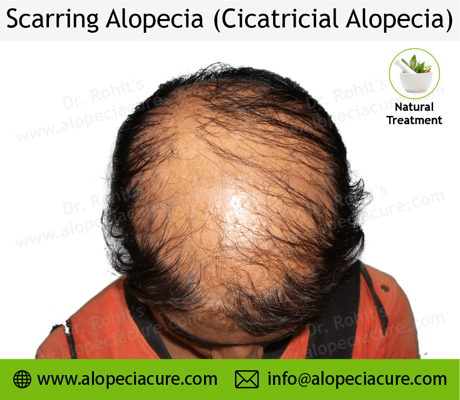 Scarrring Alopecia