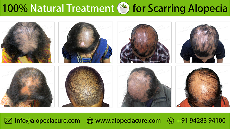 scarring alopecia