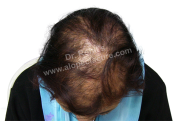 hair loss due to Chemicals Side Effects
