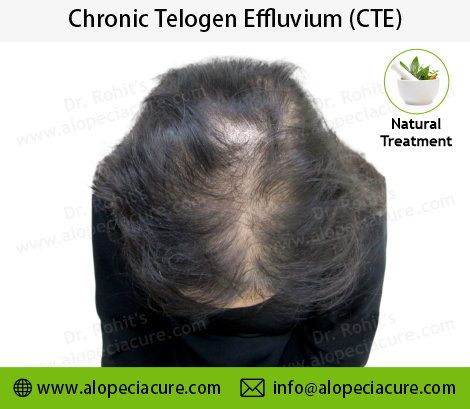 chronic telogen effluvium