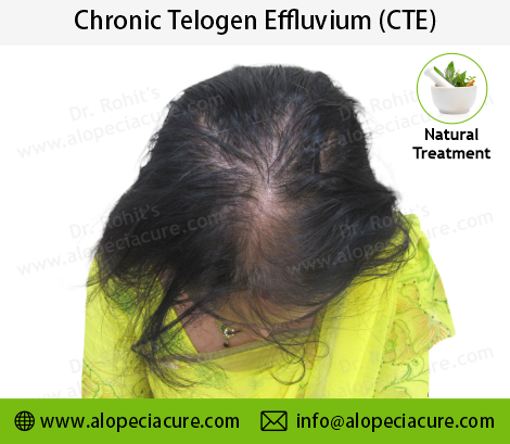 chronic telogen effluvium