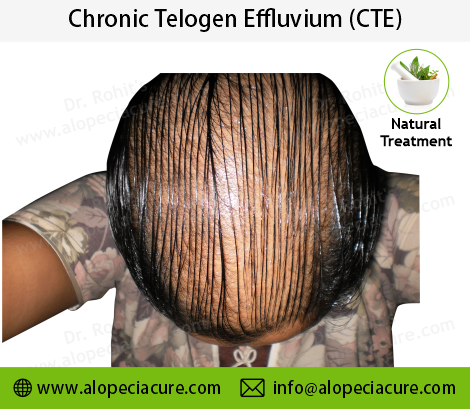 chronic telogen effluvium