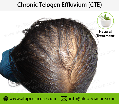 chronic telogen effluvium