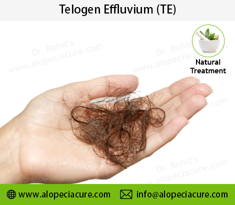 telogen effluvium