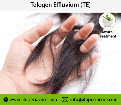 telogen effluvium