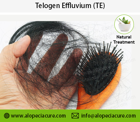 telogen effluvium