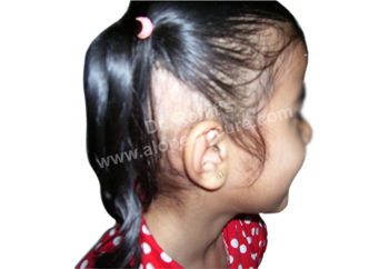 Traction Alopecia