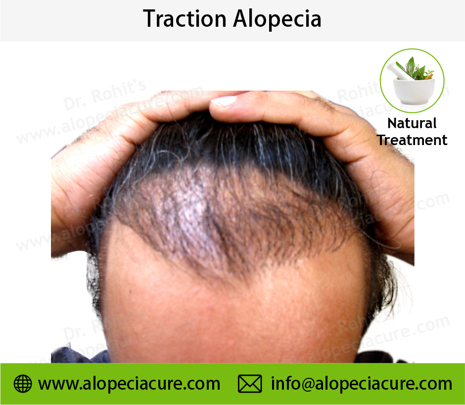 traction alopecia