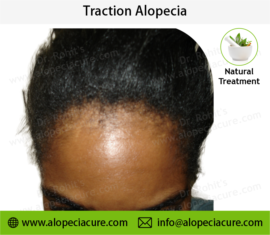 traction alopecia