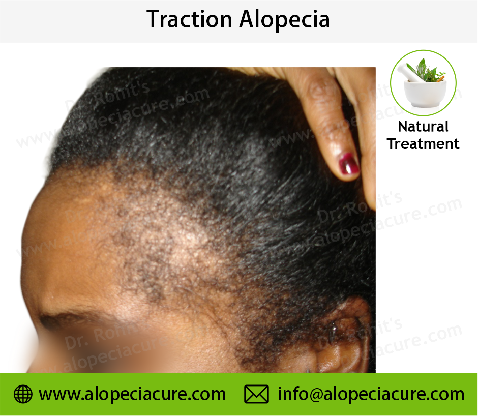 traction alopecia