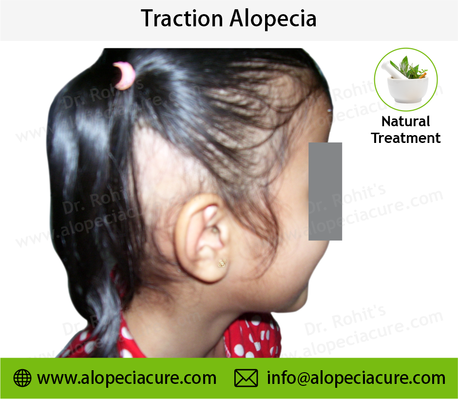 traction alopecia