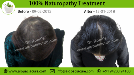 traction alopecia treatment