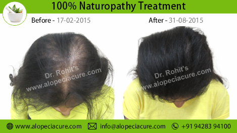 traction alopecia treatment