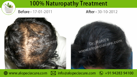 traction alopecia treatment