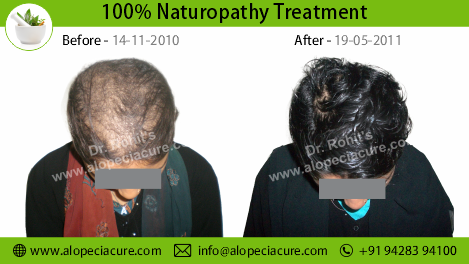 traction alopecia treatment