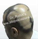 Transient Alopecia Areata