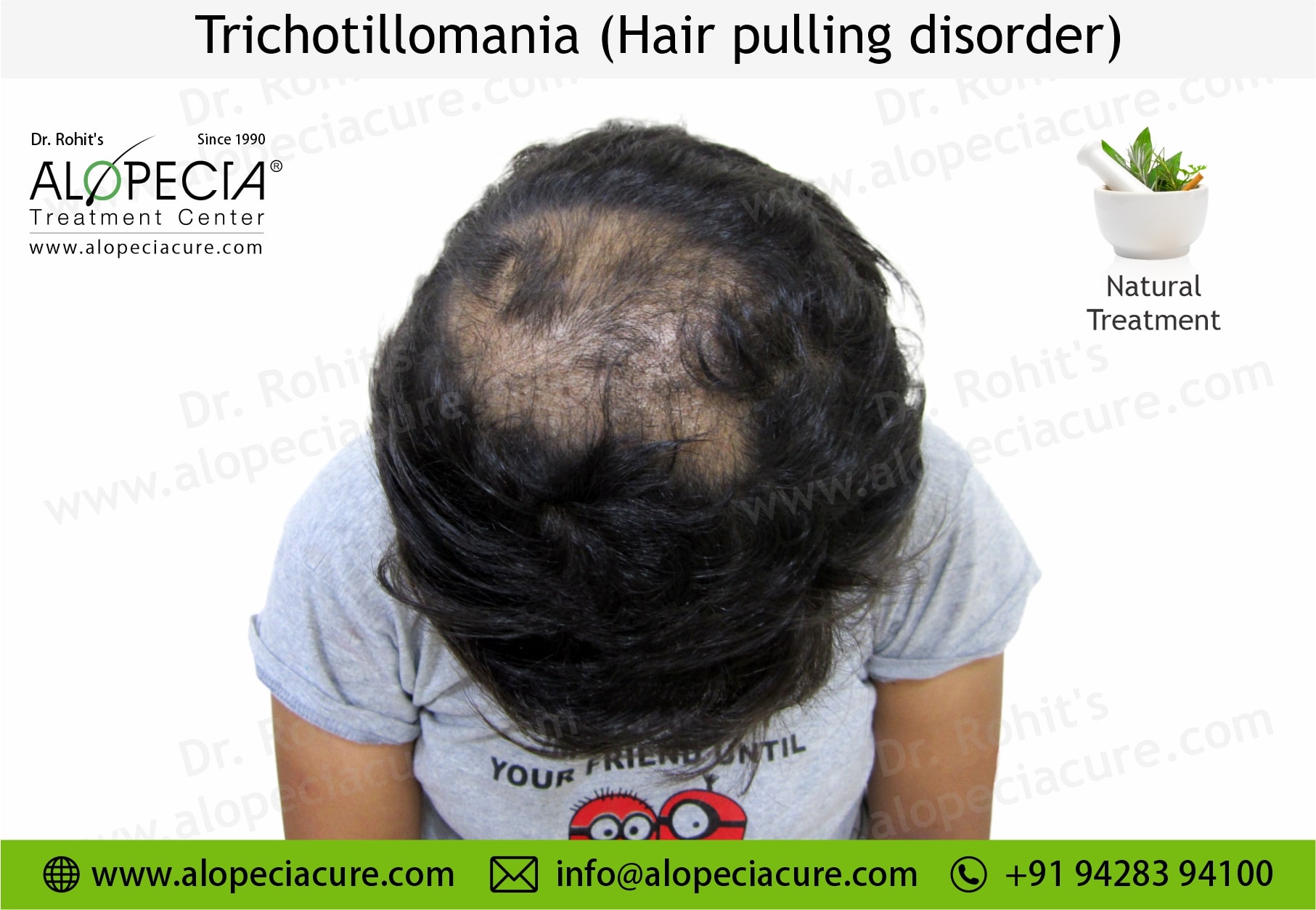 Trichotillomania(Hair Pulling Disorder): Symptoms & Treatment – Vedix