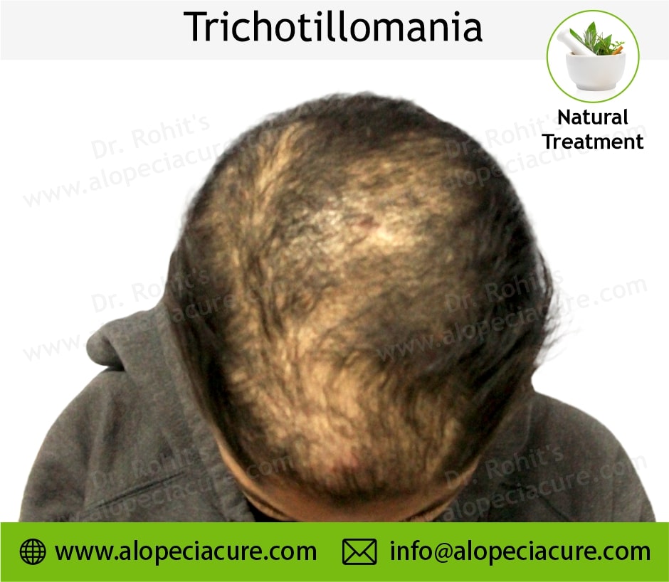 trichotillomania