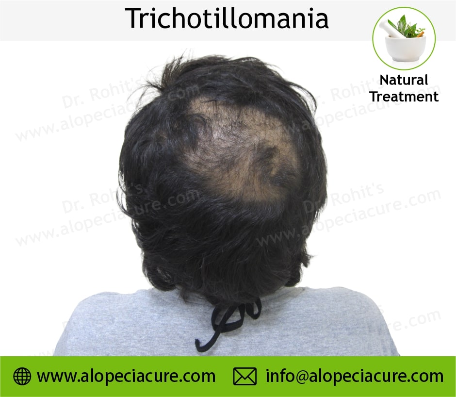 trichotillomania