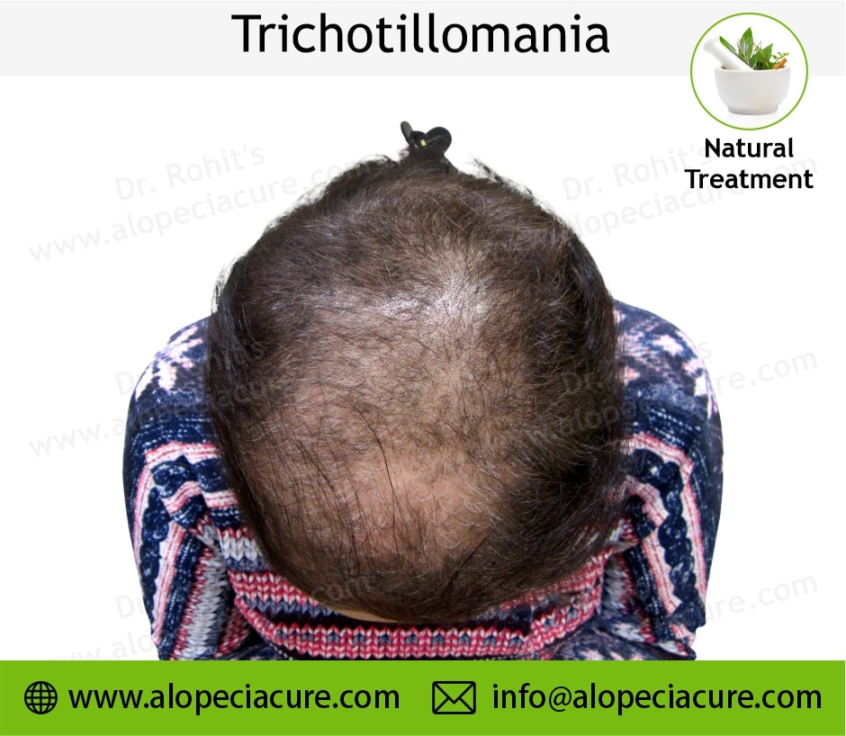 trichotillomania