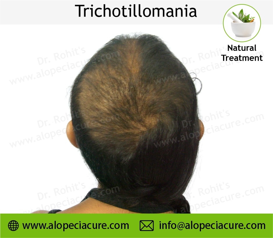 trichotillomania