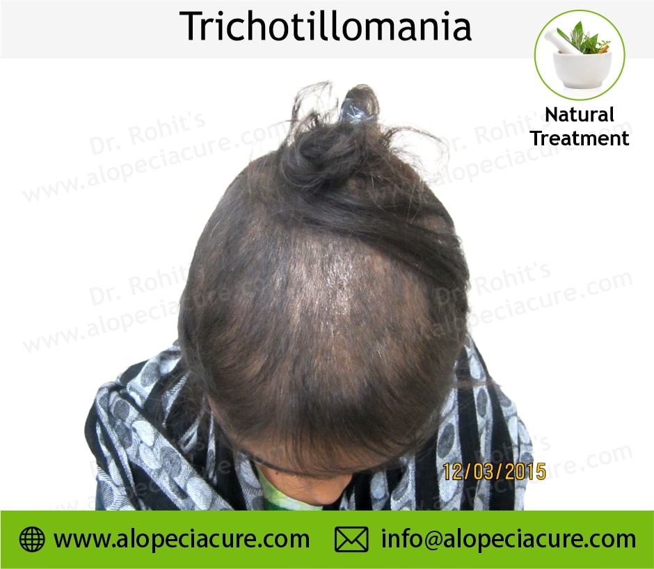 trichotillomania