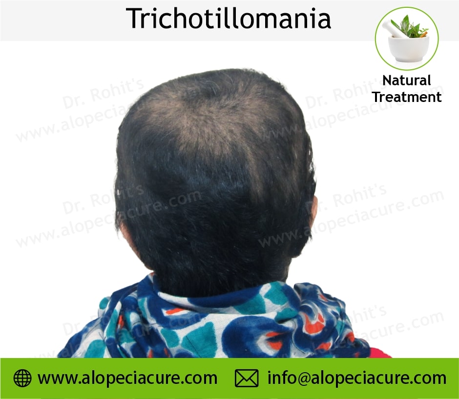 trichotillomania