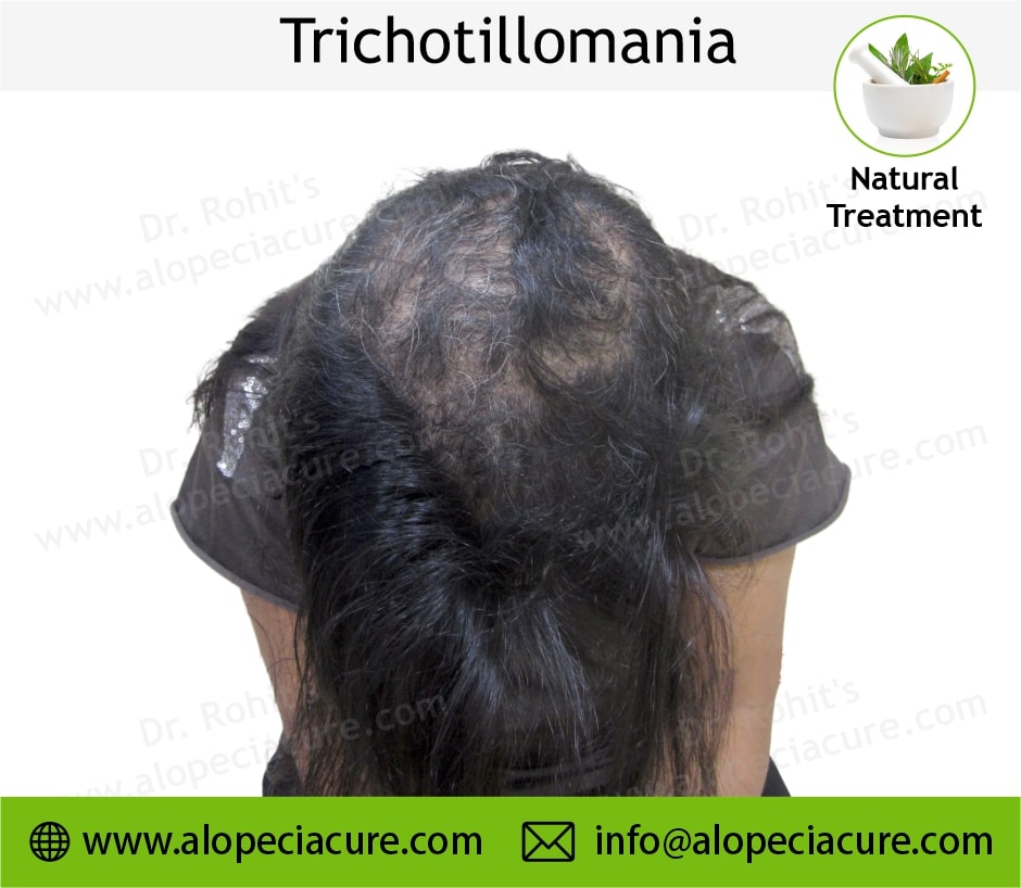 trichotillomania