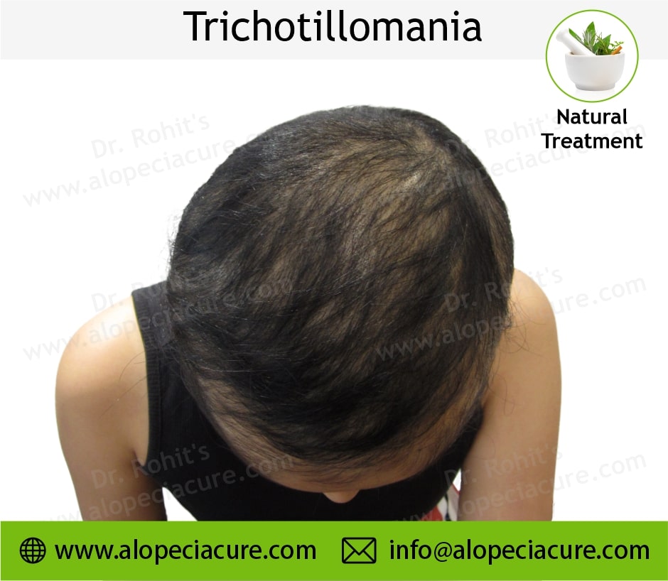 trichotillomania