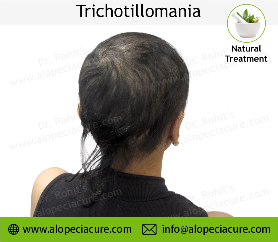 trichotillomania