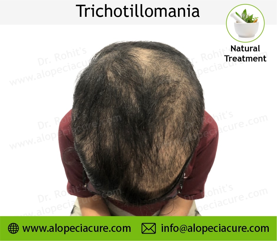 trichotillomania