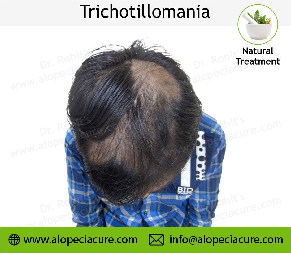 trichotillomania