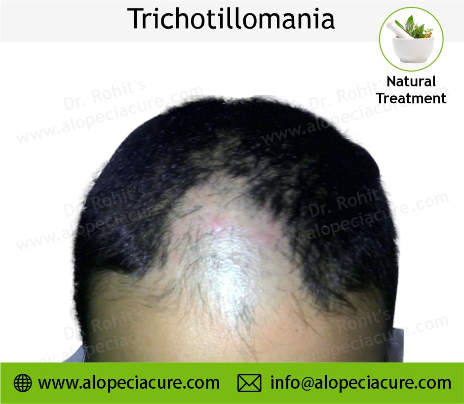 trichotillomania