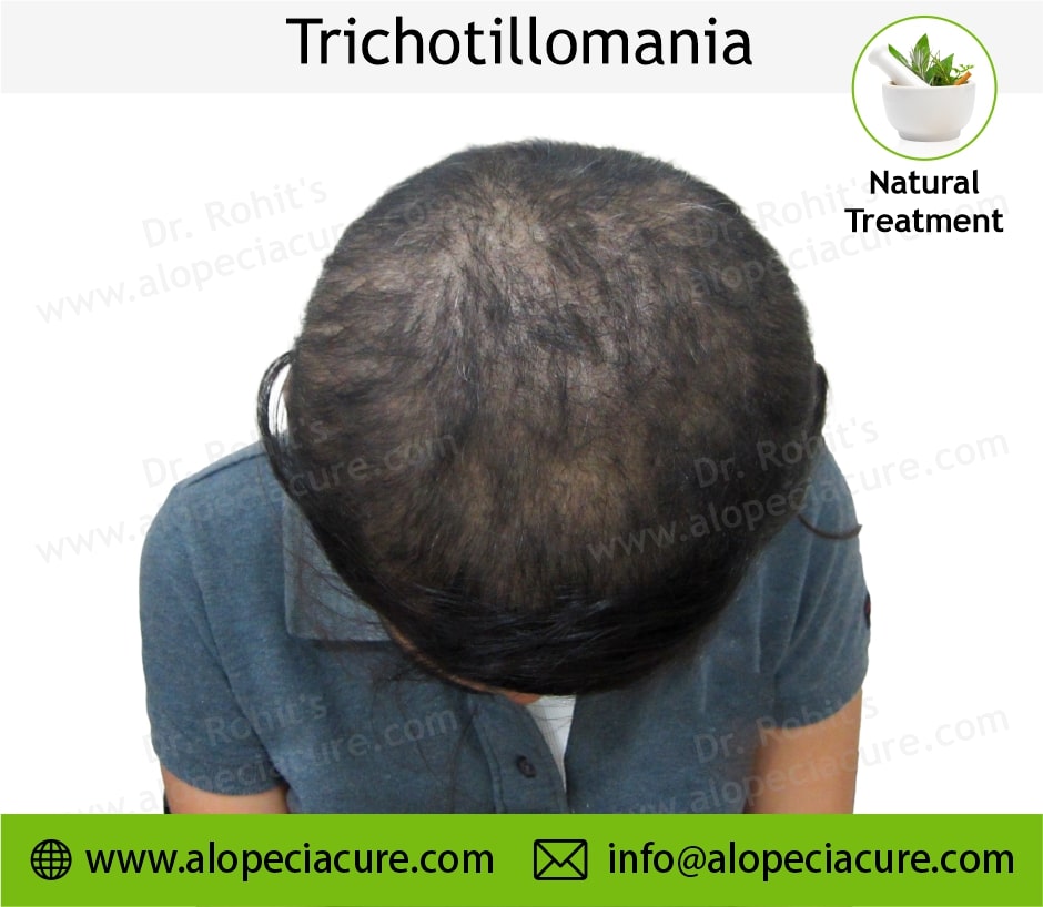 trichotillomania