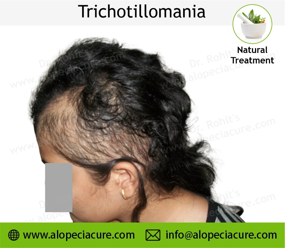 trichotillomania