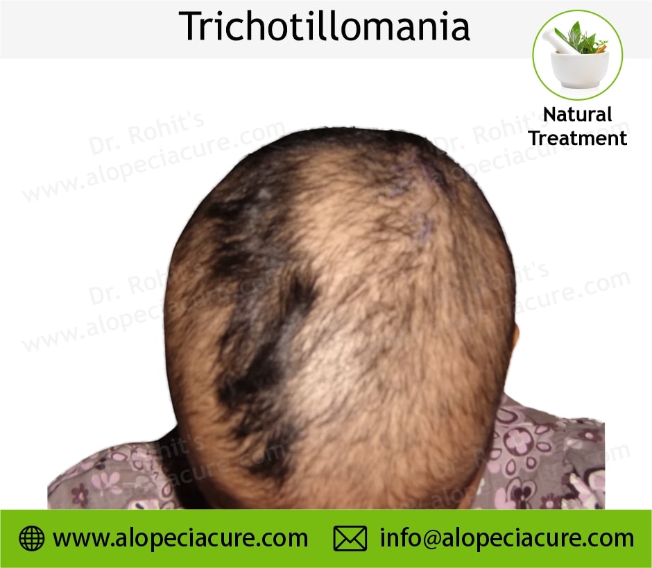 trichotillomania