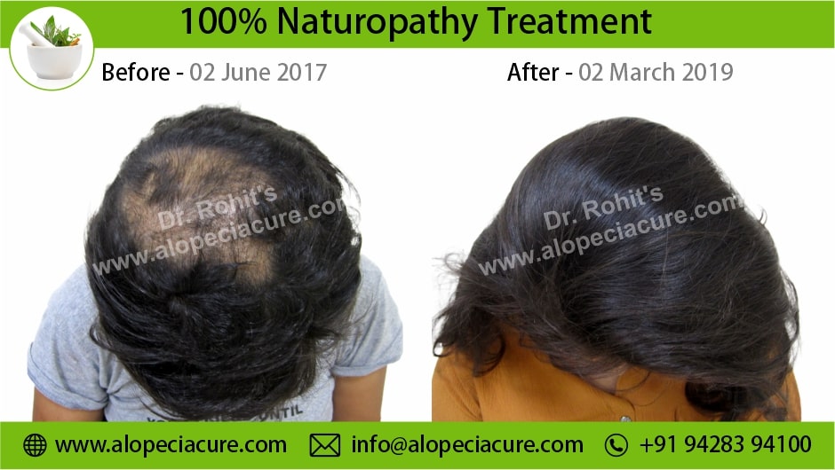 trichotillomania treatment