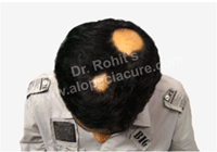 alopecia areata